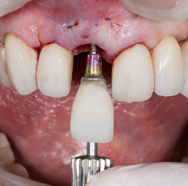 Full Mouth Implants