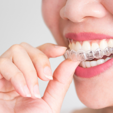 Invisible Braces