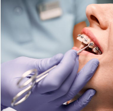 Metal Braces