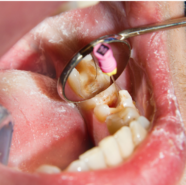 Root Canal