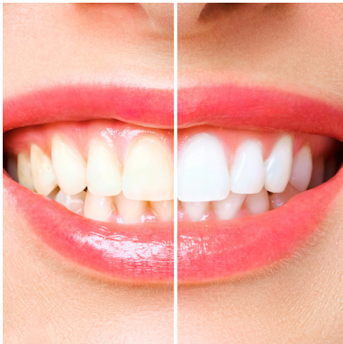 Teeth Whitening
